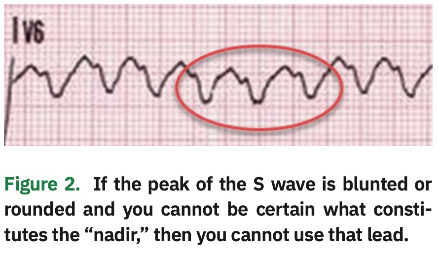 Wide Complex Tachycardias: Making the Brugada Criteria More User Friendly
